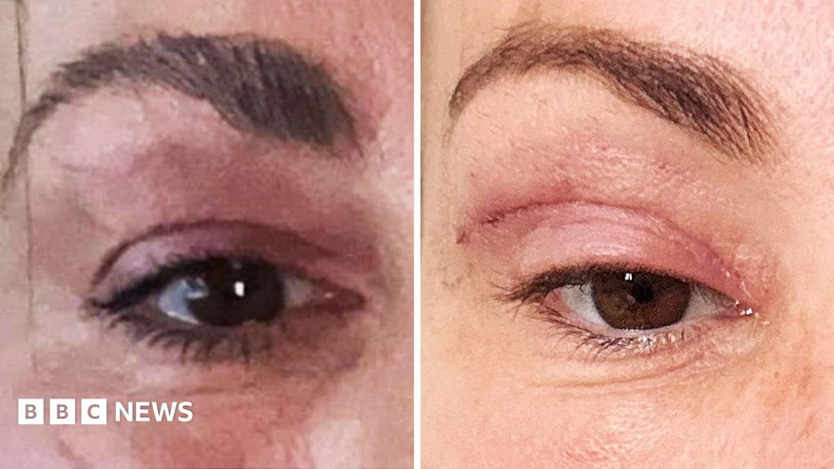 'My eyelids became infected - I was scared to sleep'