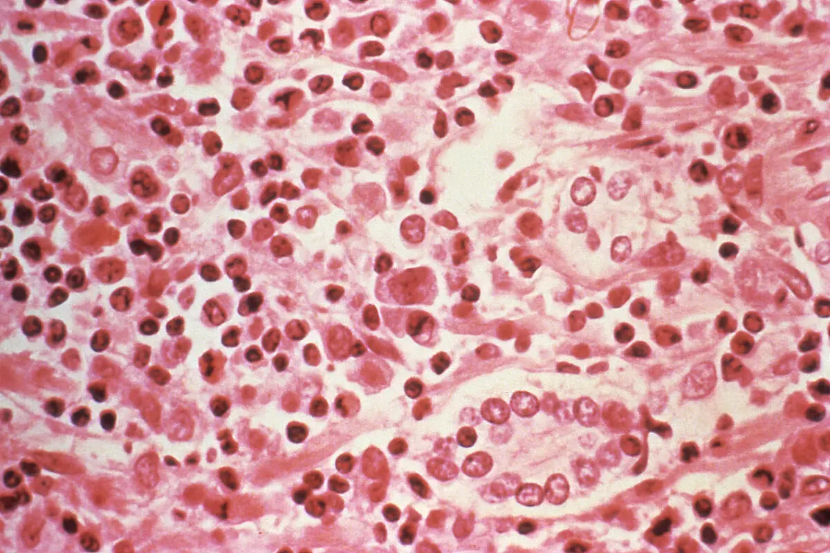 Hantavirus case confirmed in Mohave County